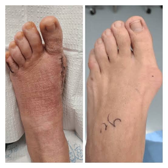 Pé no pós-operatório de cirurgia de joanete, com cicatriz e inchaço